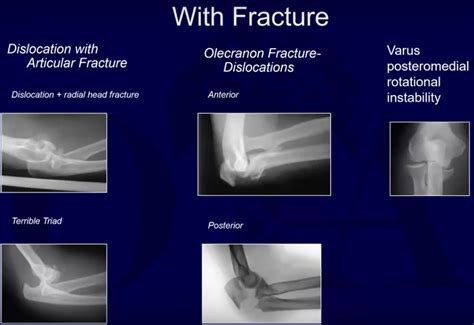 ramble elbow trite ***olate|Complex Elbow Trauma and Instability: What's this about a .